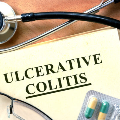 Tips to handle ulcerative colitis